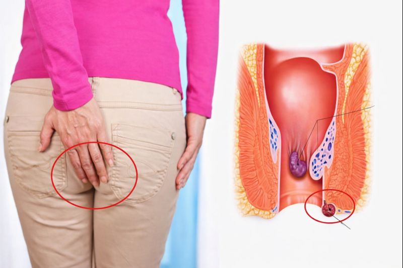 항문 탈항과 치질 증상을 이해하기 위해 여성의 엉덩이 부위와 항문 해부 구조를 함께 표현한 이미지.