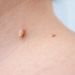 목 부위 피부에 생긴 쥐젖 병변으로, 가느다란 목이 달린 말랑한 돌출 형태의 양성 피부 병변이 관찰되는 실제 피부 모습