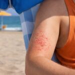 강한 햇빛 아래 해변에서 선탠 중인 성인의 팔에 땀띠(한진)가 발생한 모습으로, 파라솔 그늘 밖으로 노출된 팔 부위에만 붉은 발진이 나타나 있어 햇빛과 땀, 열 노출이 땀띠 발생에 영향을 주는 상황을 보여준다